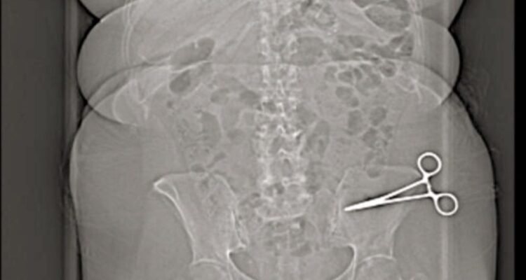 Mujer sufrió terribles síntomas durante meses: médicos dejaron tijera dentro de su abdomen en Italia
