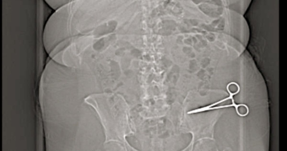 Mujer sufrió terribles síntomas durante meses: médicos dejaron tijera dentro de su abdomen en Italia