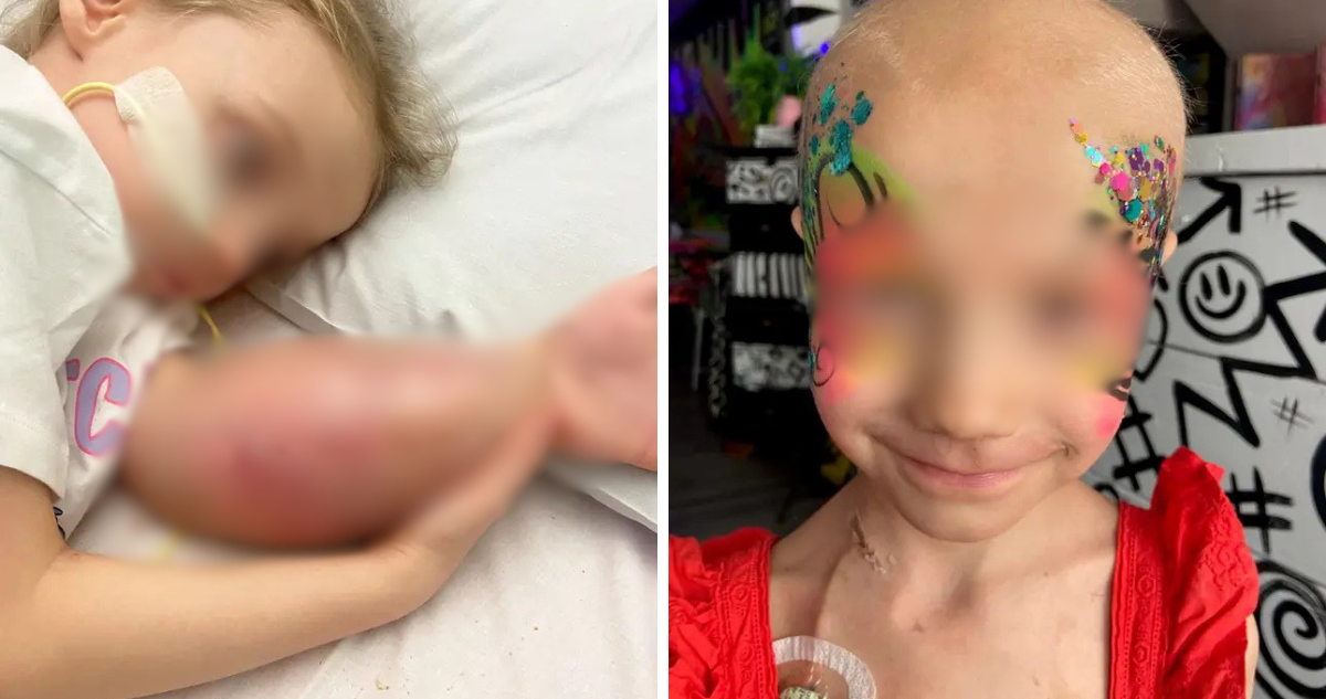 Pensaron que su hija sufrió esguince en su brazo y resultó ser cáncer