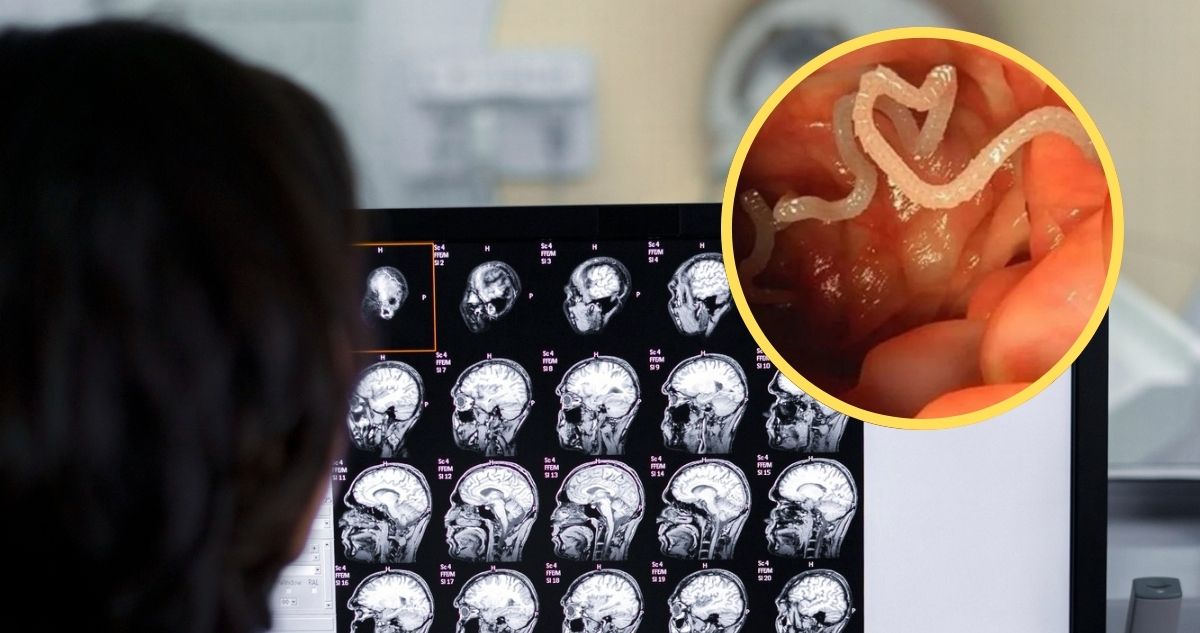 El calvario de una inglesa con neurocisticercosis y 38 parásitos en su cerebro tras un viaje a India
