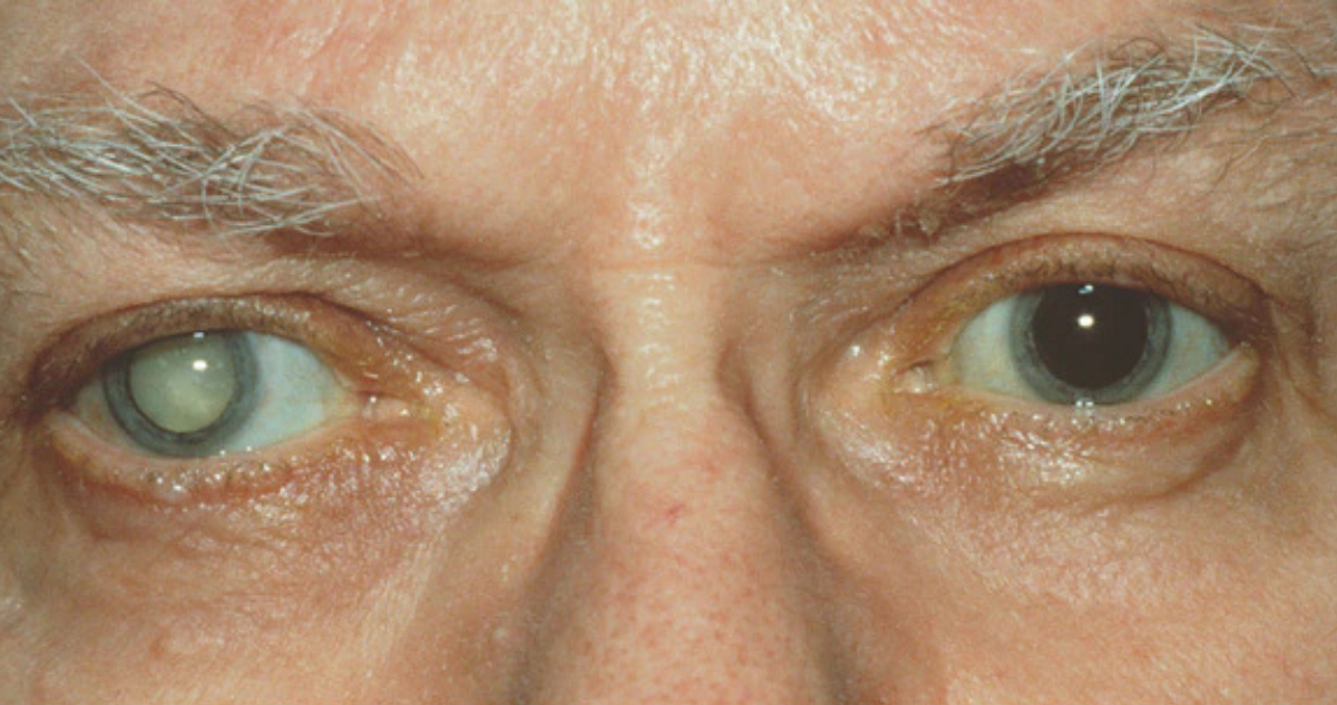 Cataratas 