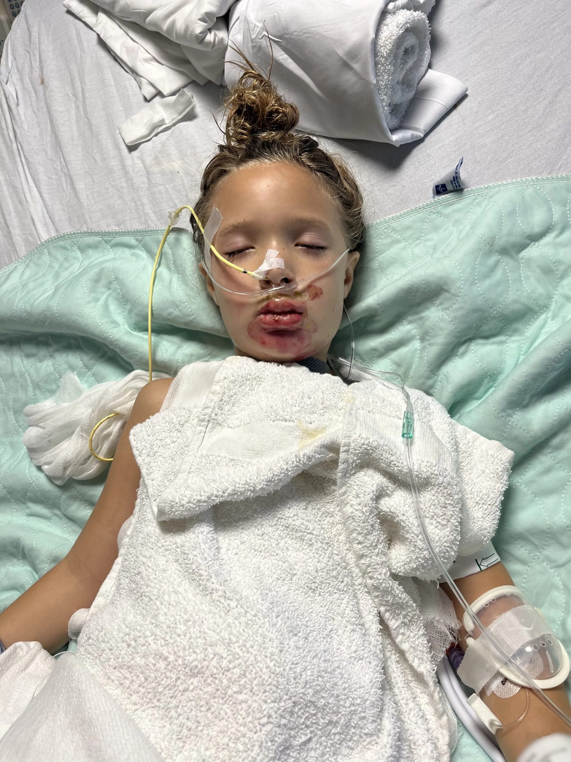 Alerta por juguete sensorial que se vende en Chile y que puede provocar graves quemaduras  en niños
