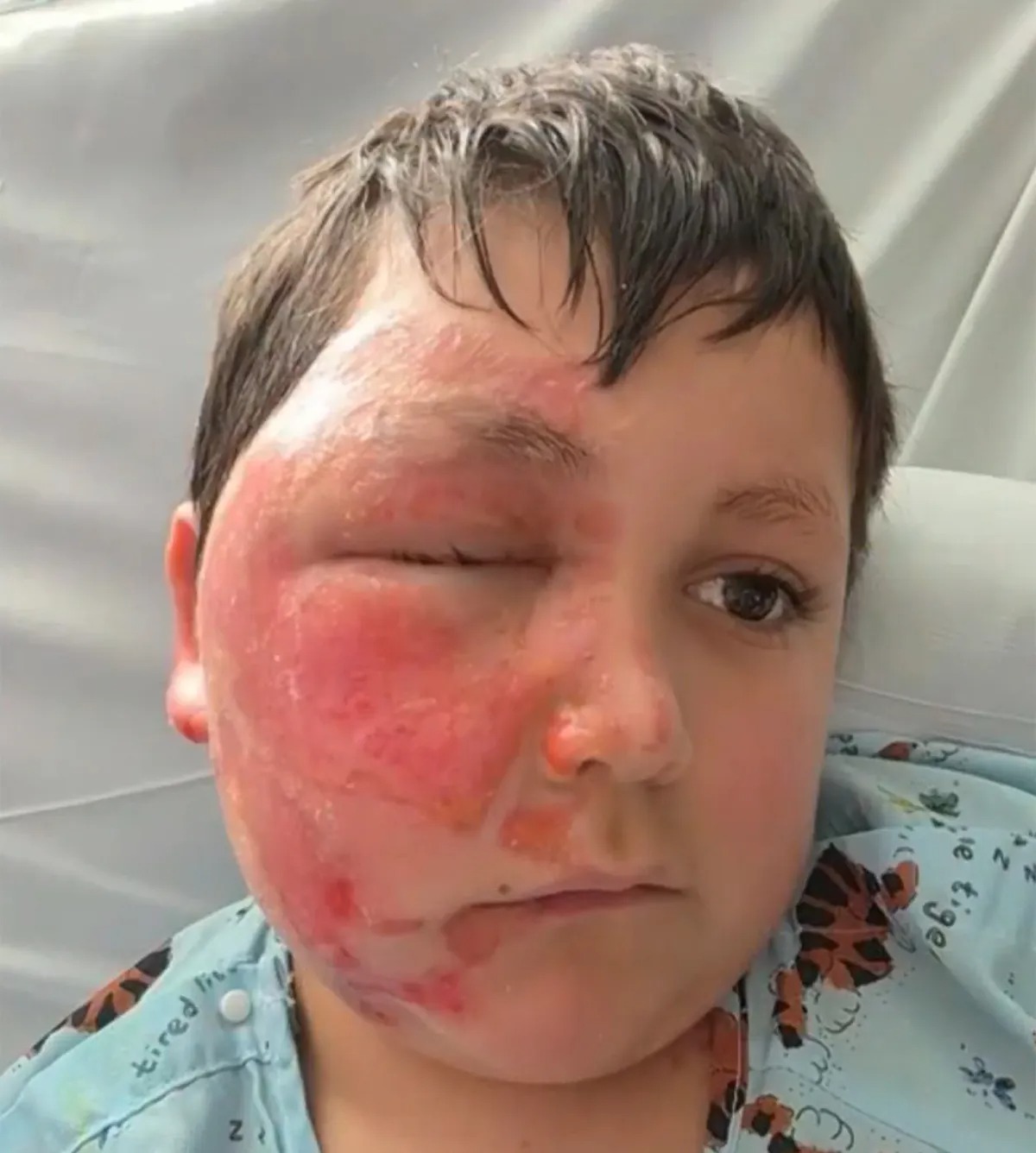 Alerta por juguete sensorial que se vende en Chile y que puede provocar graves quemaduras  en niños