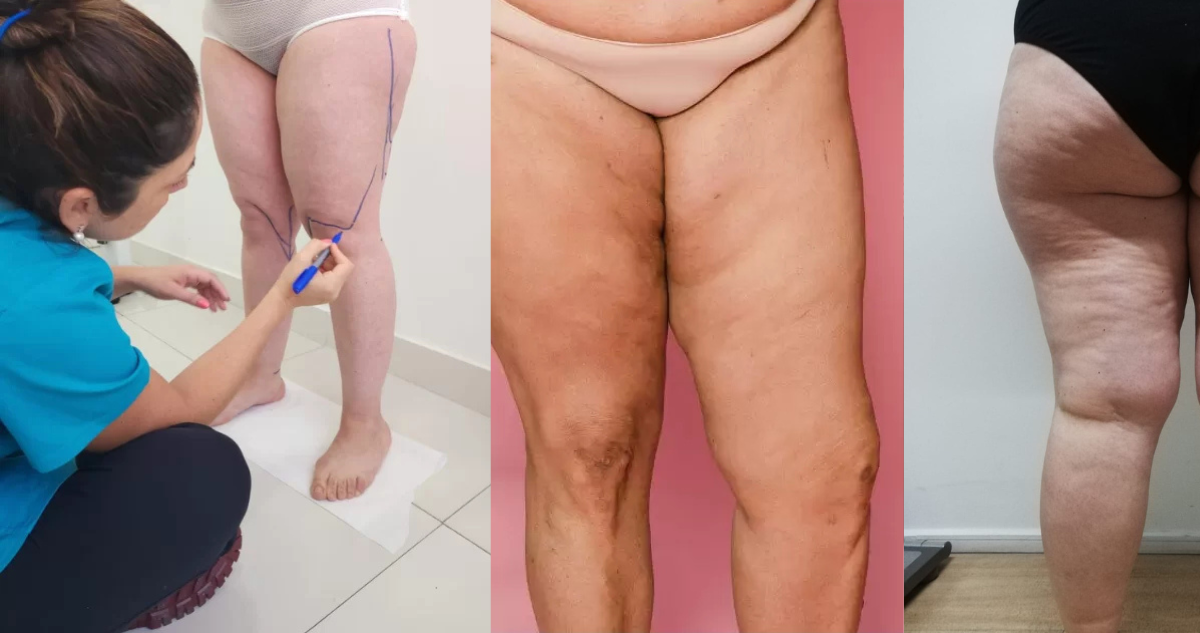 No tiene cobertura GES: qué es lipedema, la enfermedad que se confunde con obesidad y cómo se trata