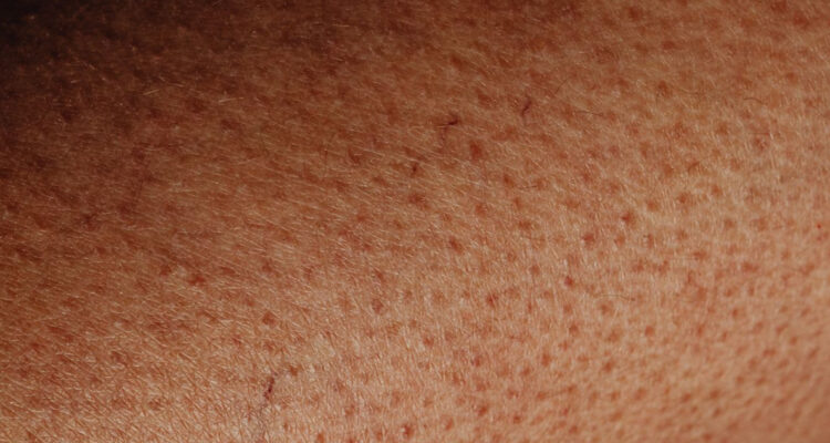 Pelos encarnados