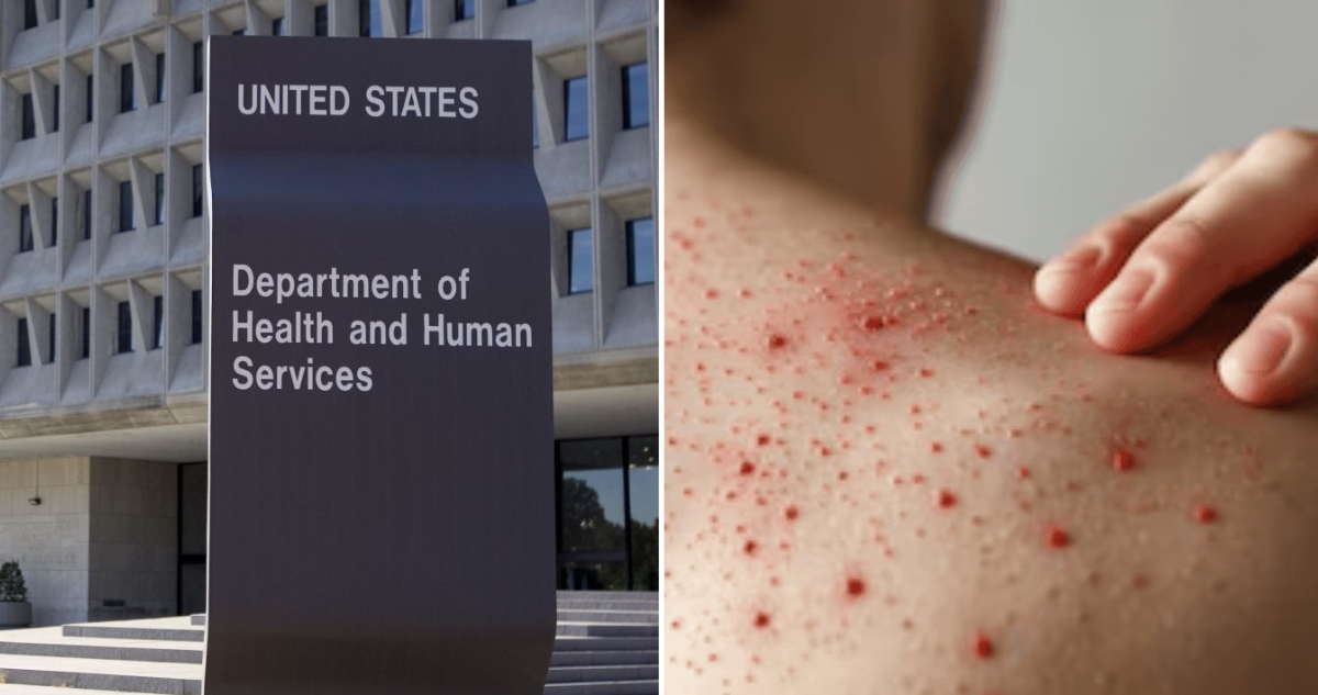 Peor brote de sarampión en EEUU