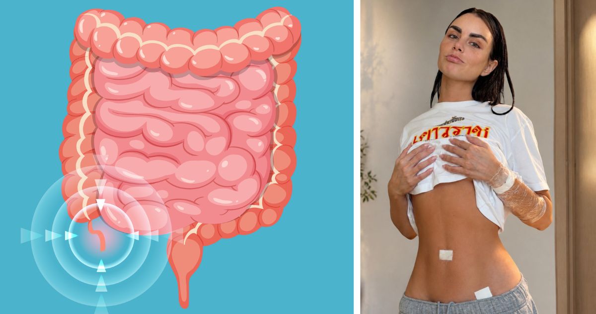 Los síntomas más raros de una apendicitis: Una de las 3 razones de operación urgente de Emilia Dides
