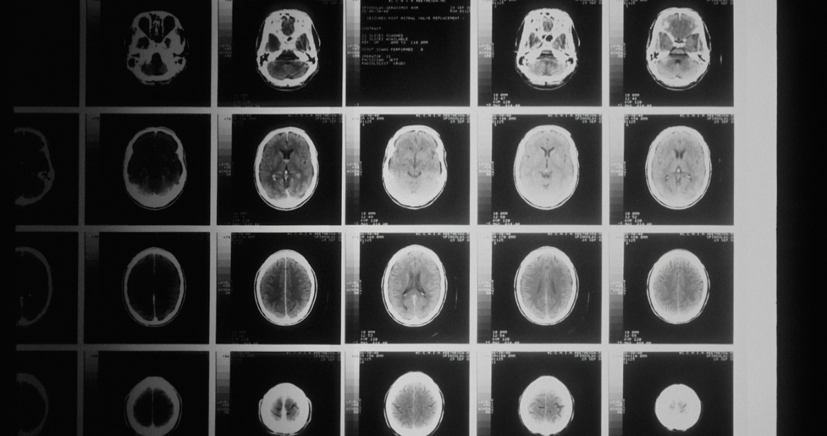 Foto de una tomografía cerebral para ilustrar nota sobre la paradoja del cáncer y el alzheimer