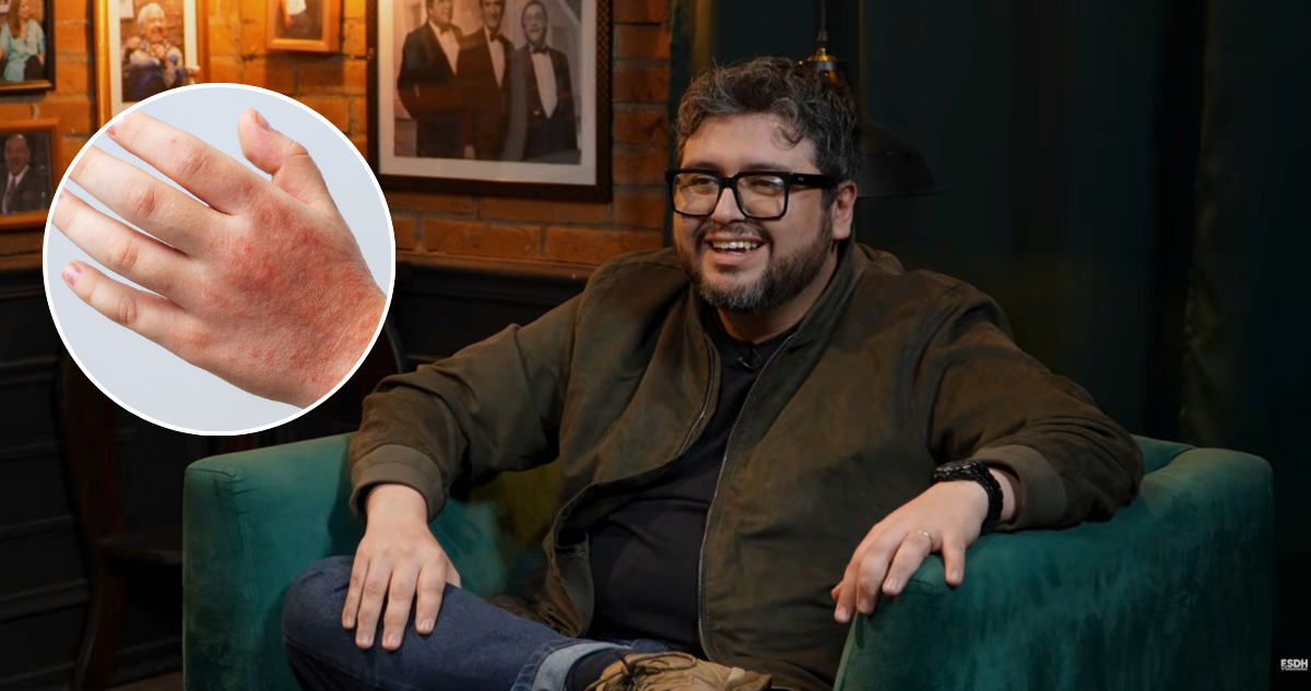 Luis Slimming contó su experiencia con urticaria por frío o urticaria a frigore