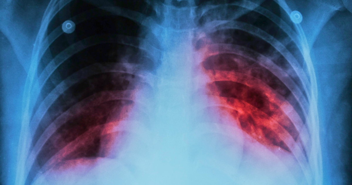 Tuberculosis