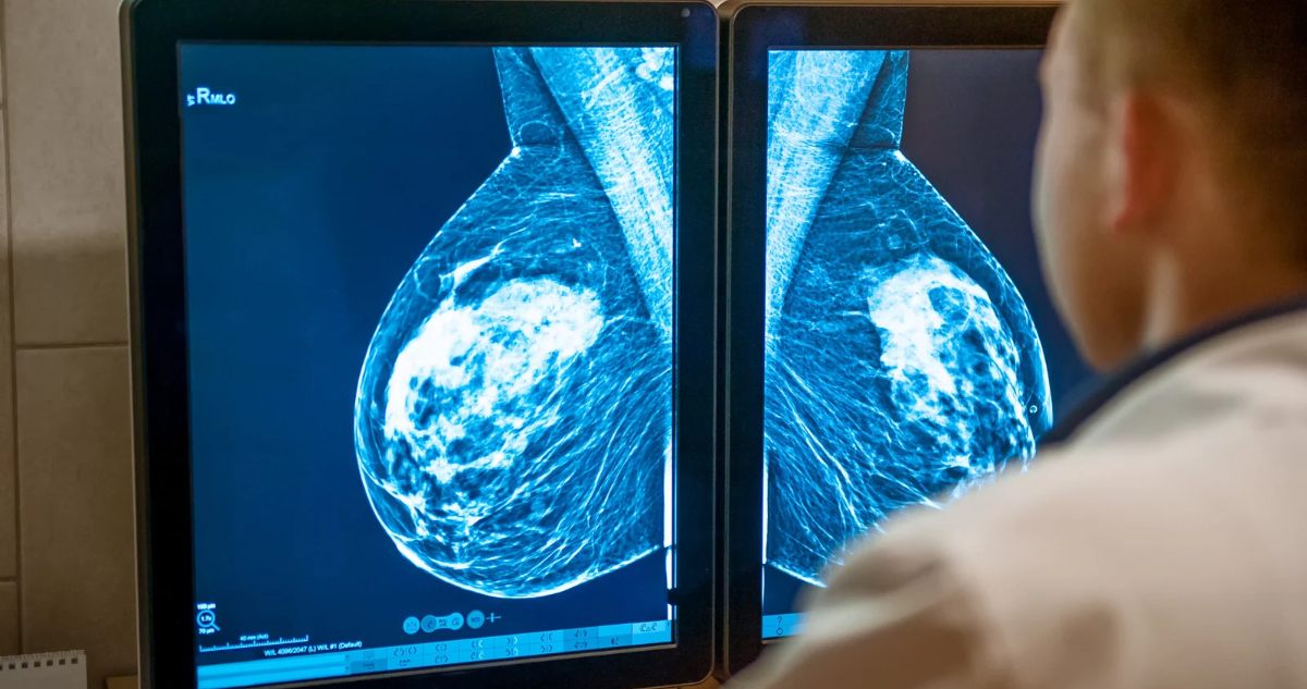 Cáncer de mama en Inglaterra