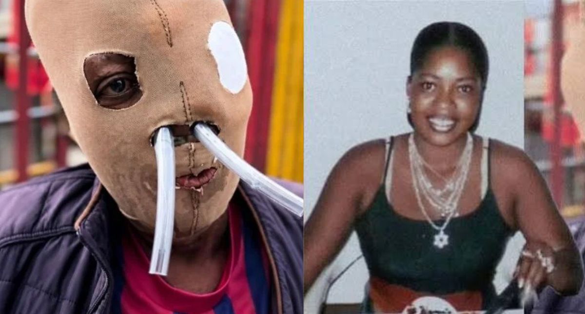 Colombiana quemada con ácido ruega por eutanasia tras 26 años de suplicio y casi 90 cirugías