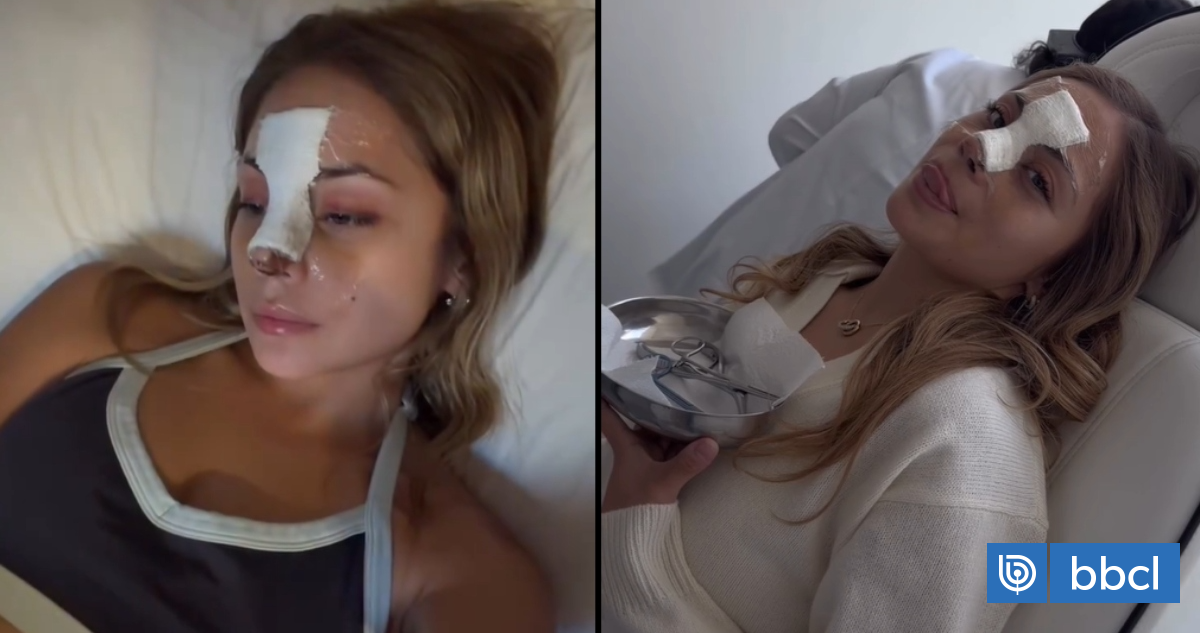 "100% salud": Skar Labra mostró antes y después de su rostro tras someterse a una intervención