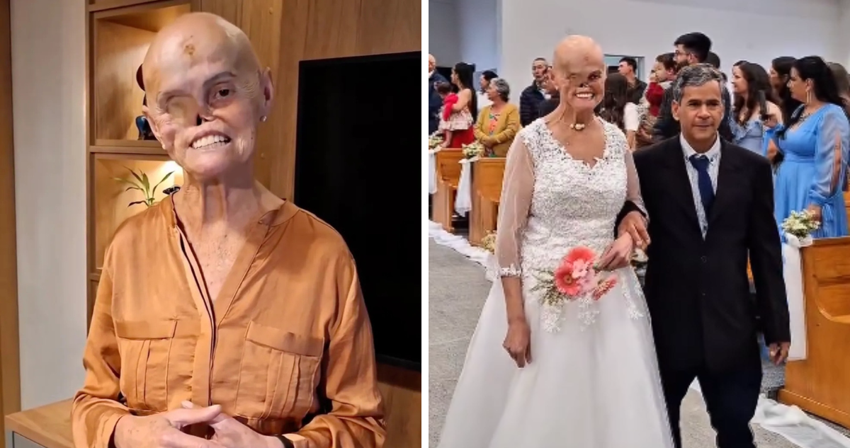 Brasileña que superó 73 diagnósticos de cáncer por una rara enfermedad cumplió su sueño de casarse