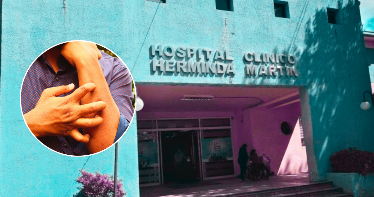 Hospital de Chillán confirma brote de sarna noruega: 13 contagiados y suspensión de prácticas