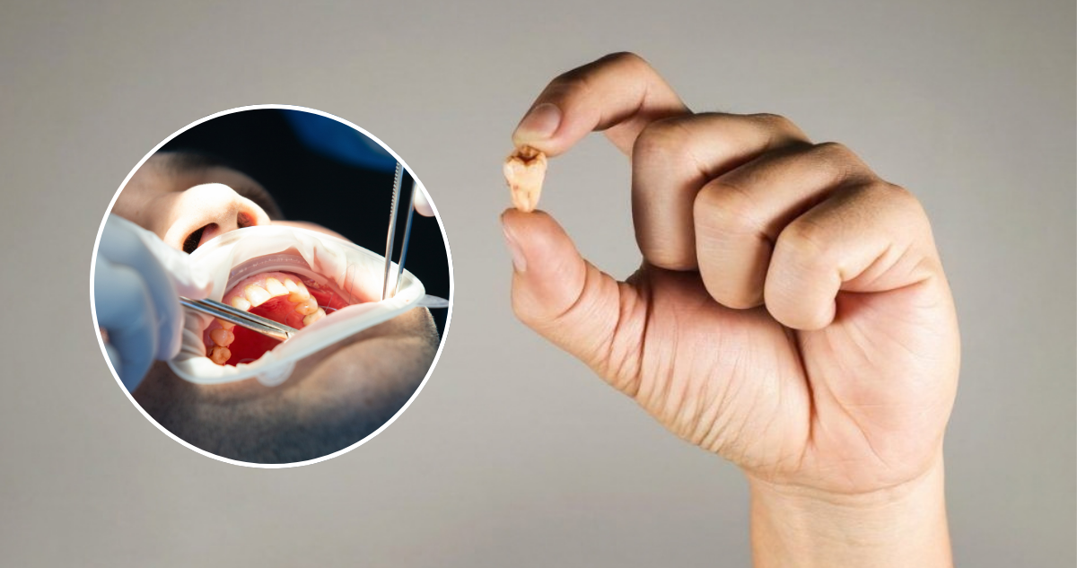 ¿Es normal que se caigan dientes con la edad?