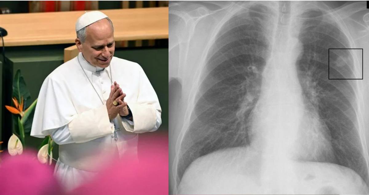 Qué es un nódulo pulmonar: la complicación de salud que afecta al papa que deberá resolver con cirugía