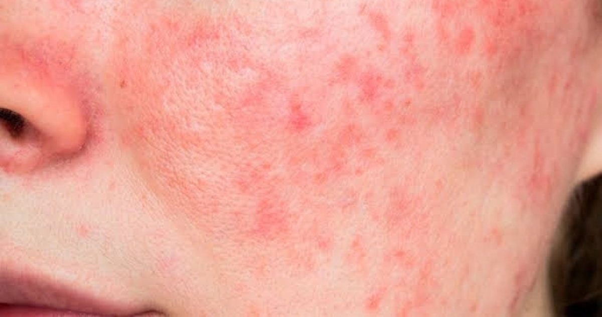https://media.biobiochile.cl/wp-content/uploads/2026/10/rosacea-sintomas.png