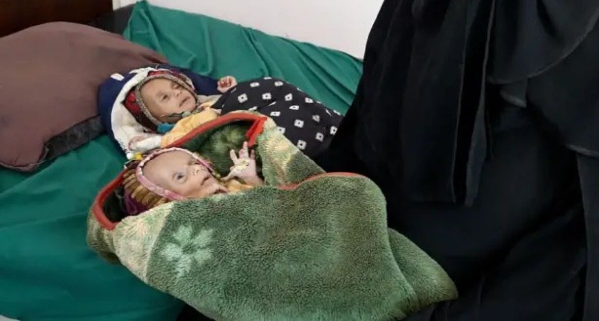 “Solo piel y huesos”: gemelos recién nacidos se vuelven el retrato mundial de la cruda crisis en Yemen