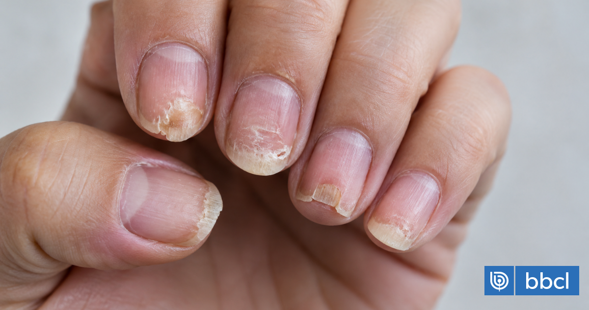 Surcos, colores y más: señales en las uñas que pueden alertar sobre enfermedades sin otros síntomas