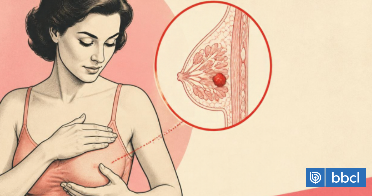 Un bulto en la mama no siempre significa cáncer: las diferencias entre un nódulo, quiste y tumor
