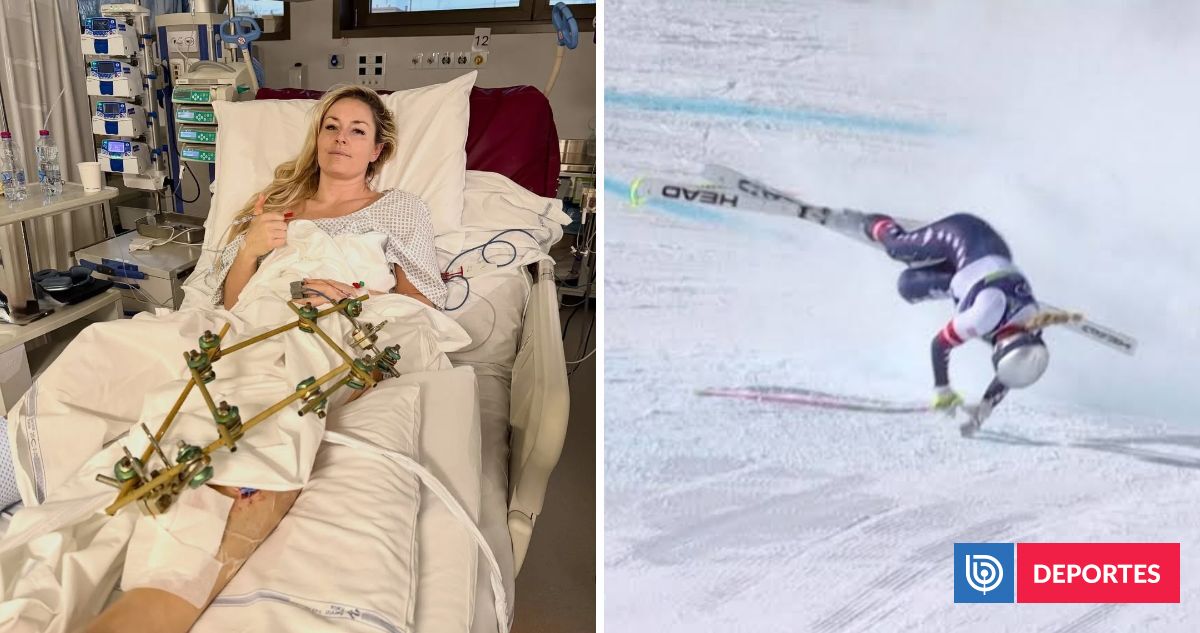 A meses de casi perder una pierna: Lindsey Vonn fue incluida por EEUU para el Mundial de Esquí