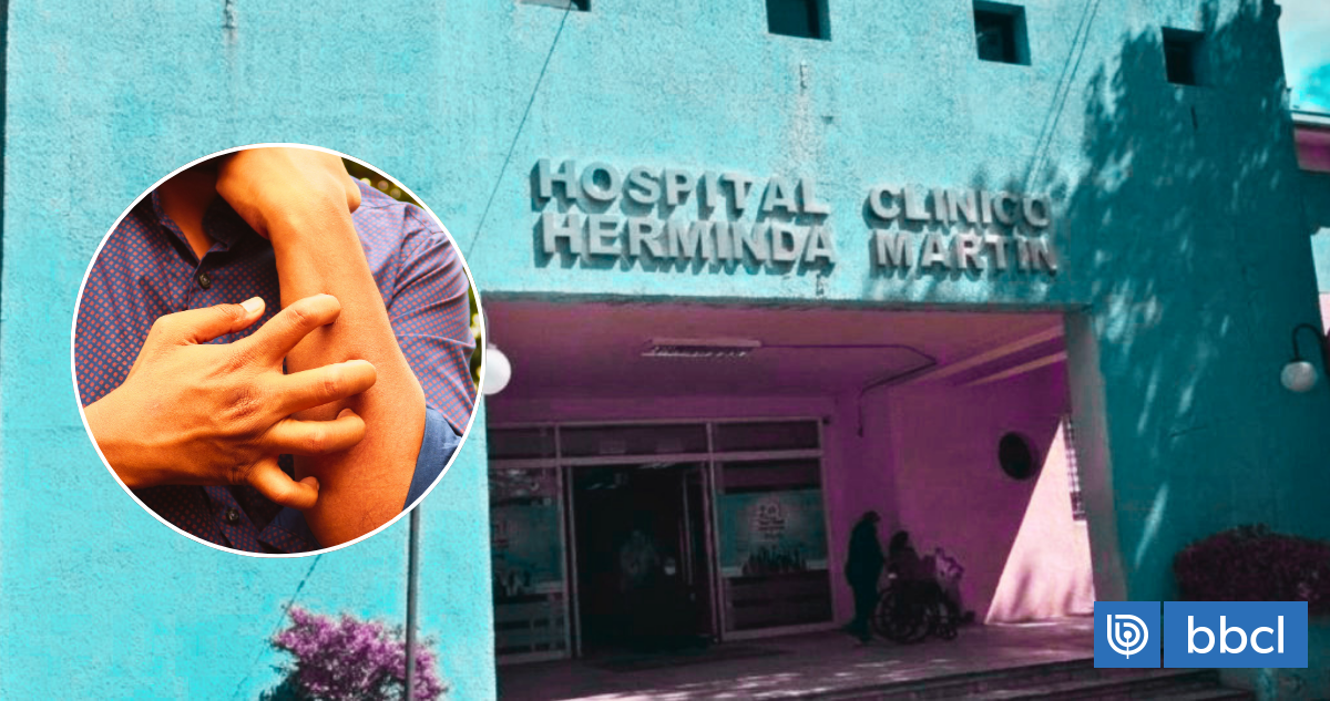 Hospital de Chillán confirma brote de sarna noruega: 13 contagiados y suspensión de prácticas