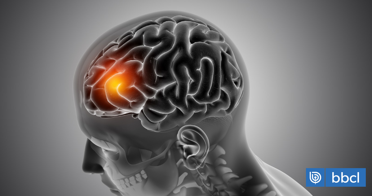 Apréndetelo de memoria: el método "RAPIDO" para identificar un ataque cerebrovascular