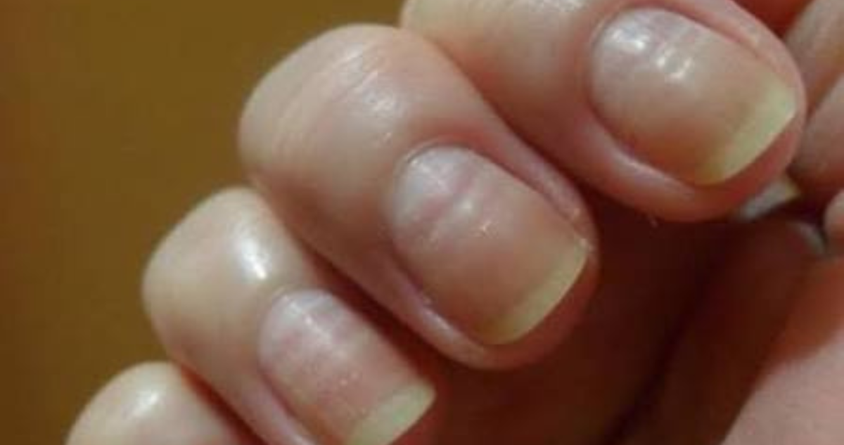 Surcos horizontales en las uñas